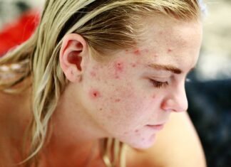 El acné es un trastorno de la piel que ocurre cuando los folículos pilosos se tapan con grasa y células cutáneas muertas, causando puntos blancos, puntos negros y granos.