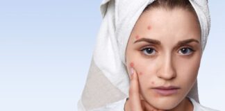 Junio, mes de concientización del acné: No se trata de una entidad exclusiva del adolescente