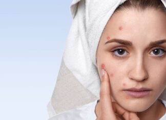 Junio, mes de concientización del acné: No se trata de una entidad exclusiva del adolescente