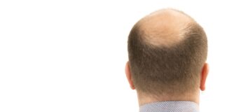 tratamiento-alopecia calvicie